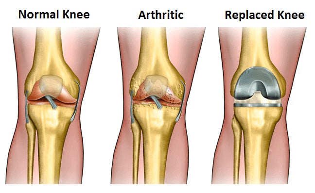 YOU HAD A TOTAL KNEE REPLACEMENT: WHAT TO EXPECT AT HOME