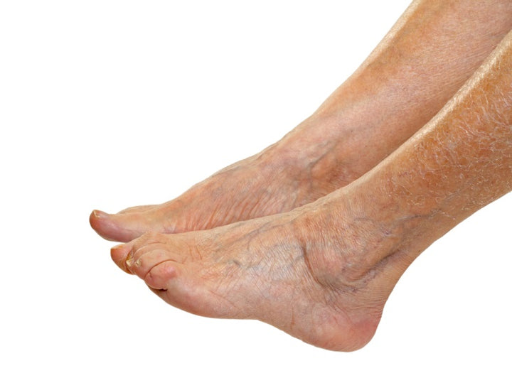 Swollen foot and swollen ankles relieved